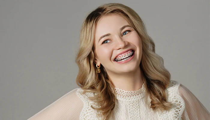 Исправление прикуса брекетами