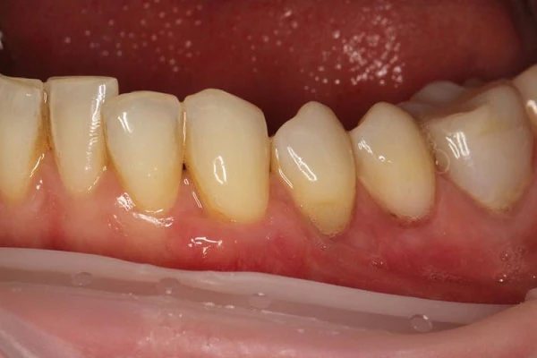 Пластика десны