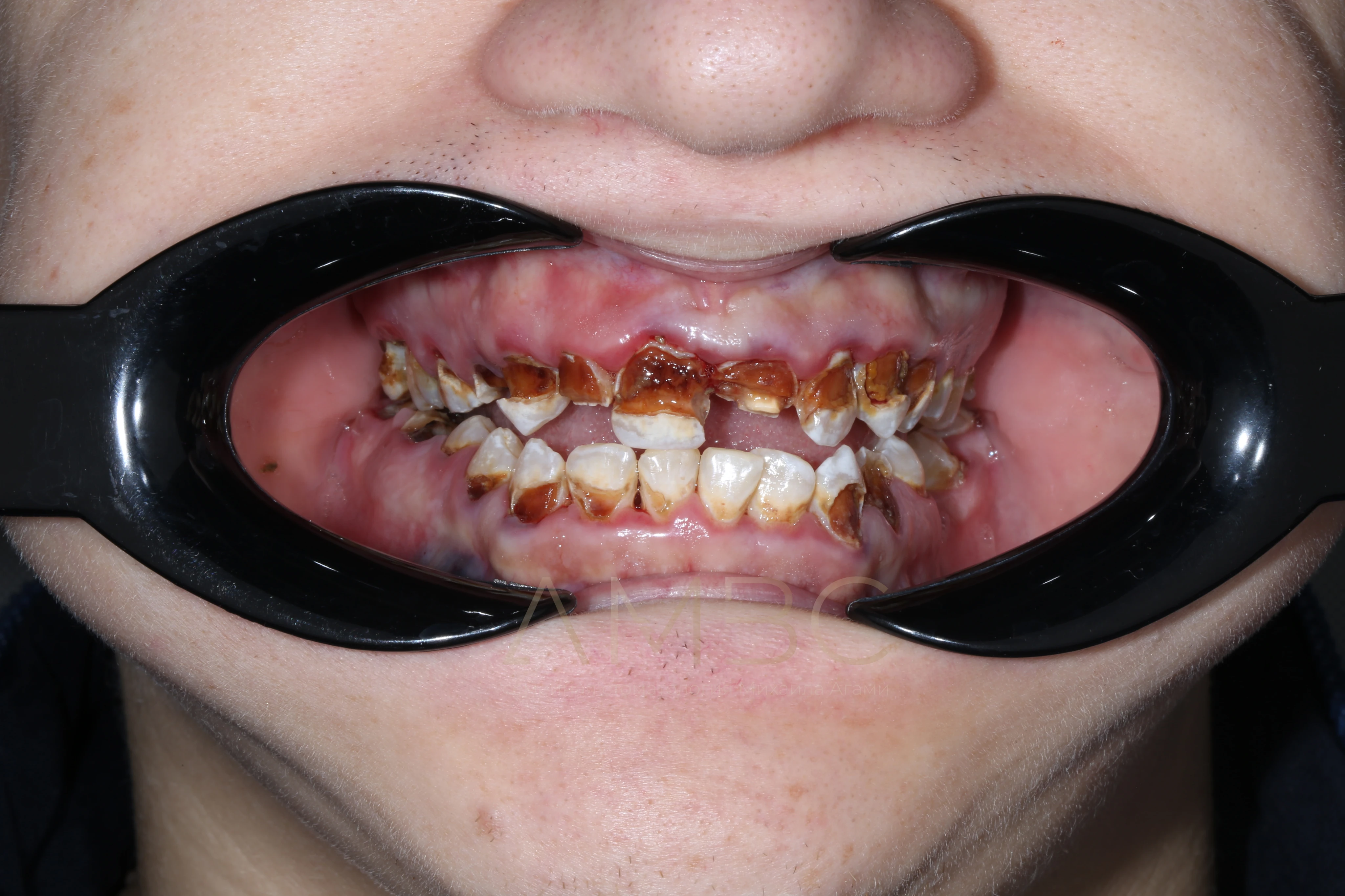 Имплантация и протезирование