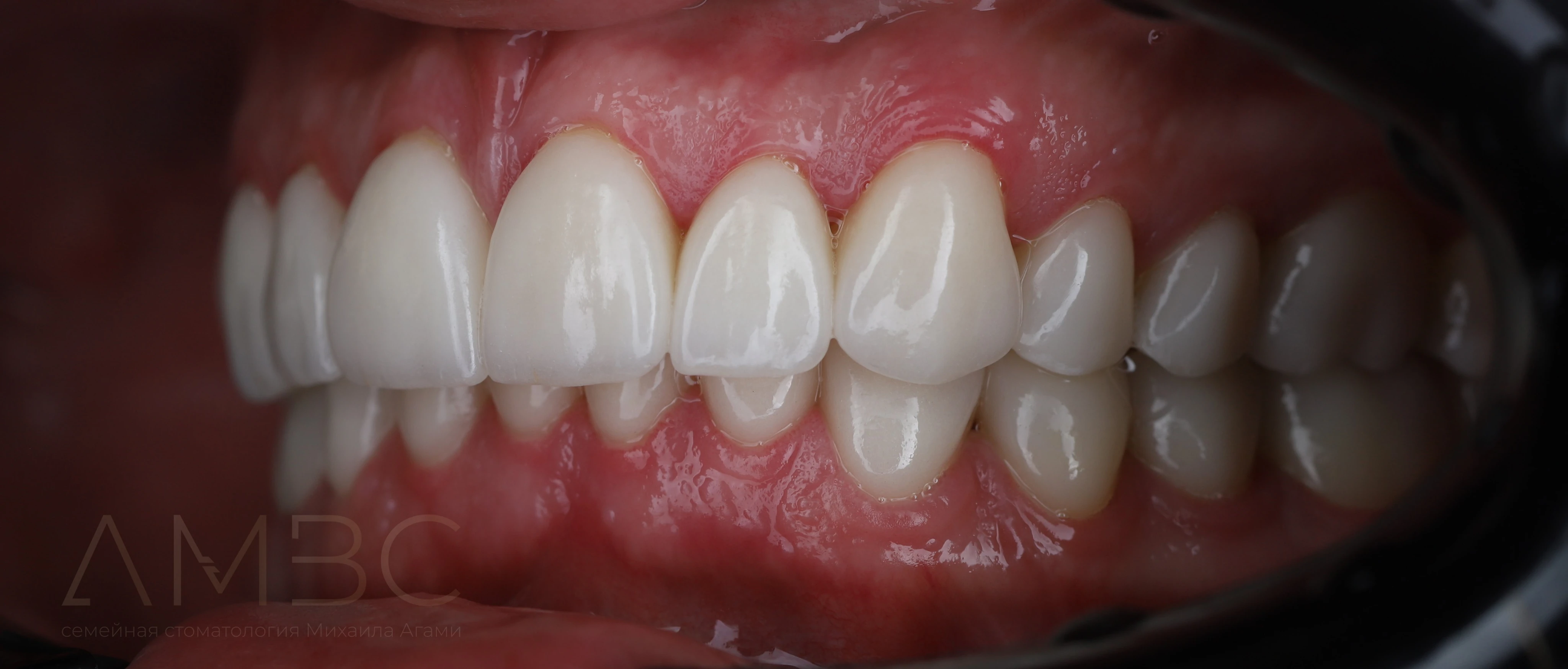 Протезирование зубов