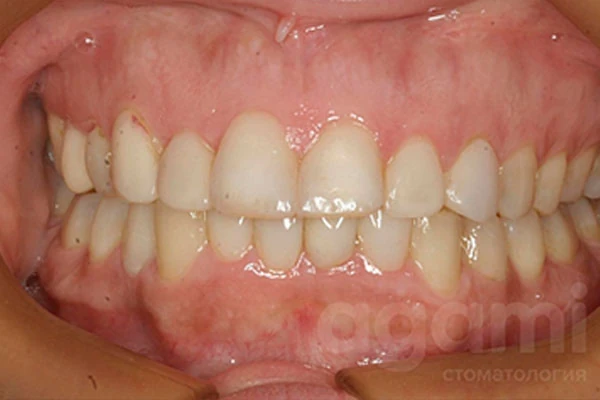 Тотальная функциональная и эстетическая реабилитация улыбки