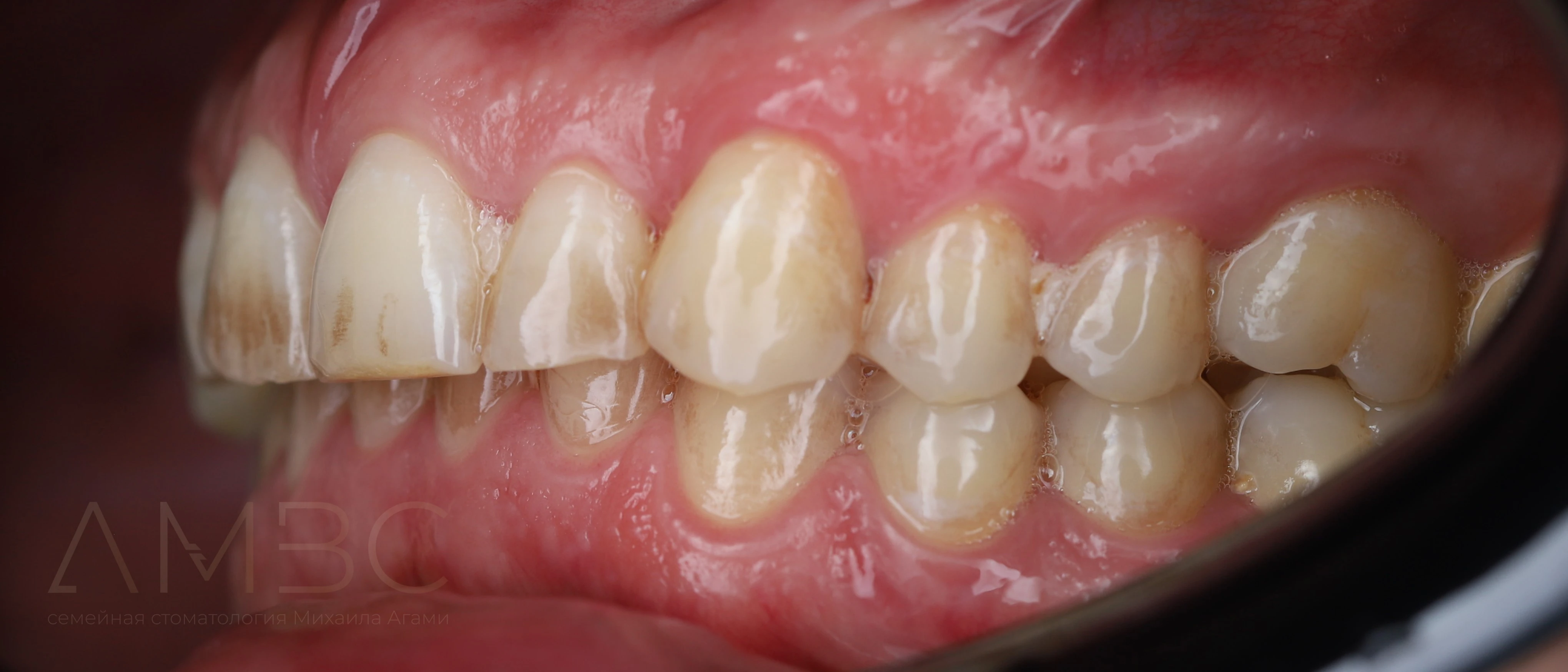 Протезирование зубов