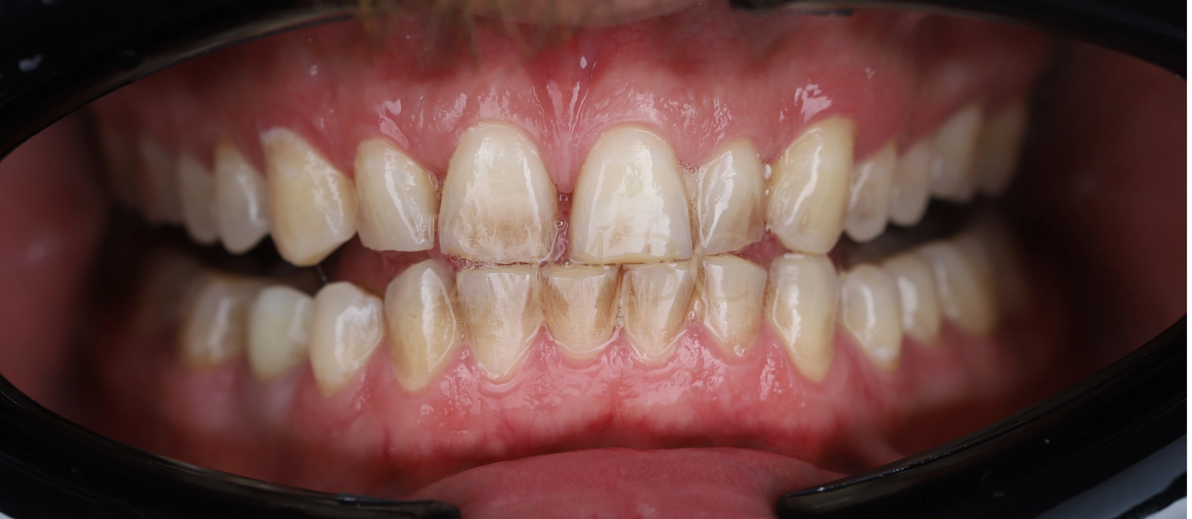 Протезирование зубов