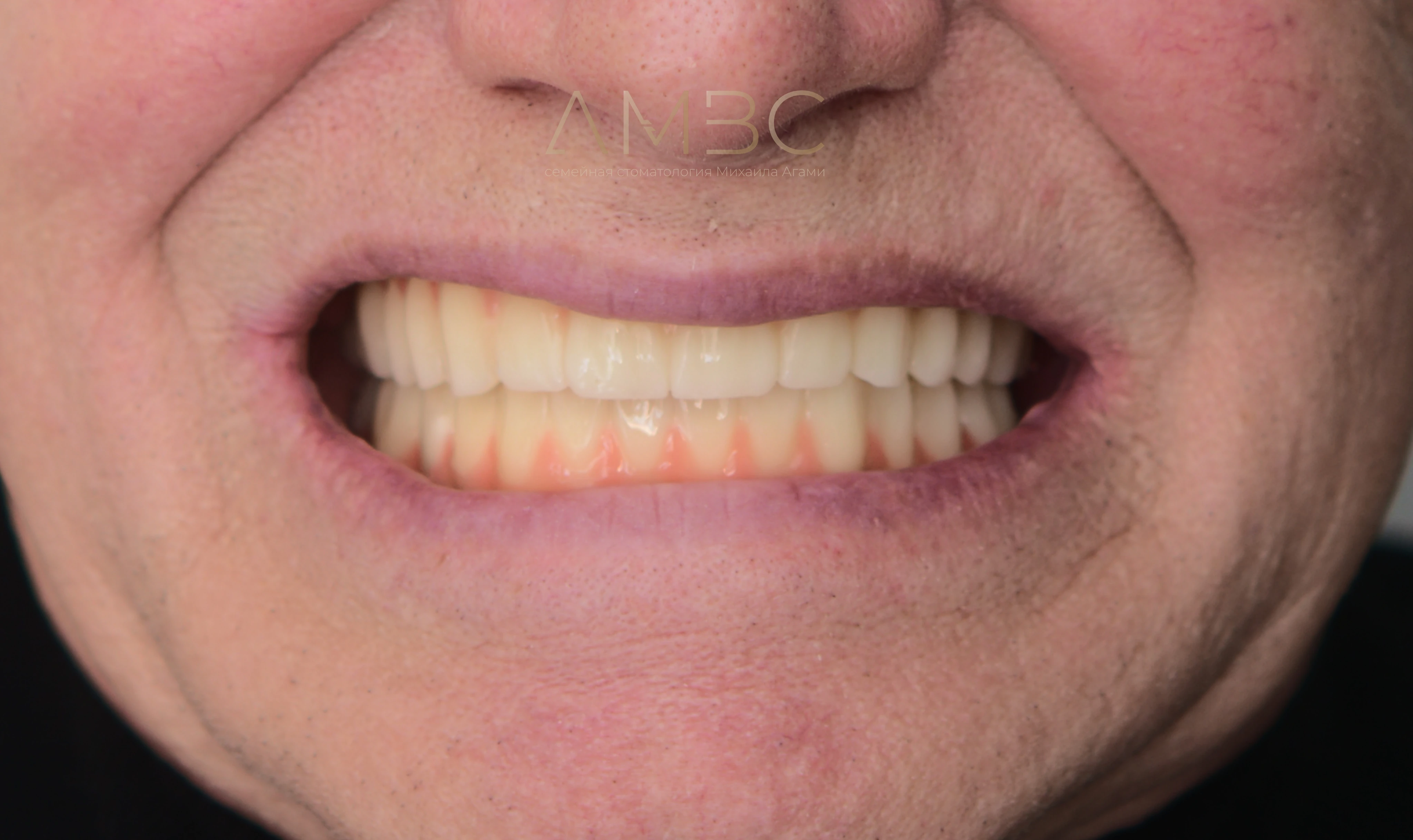 Имплантация и протезирование