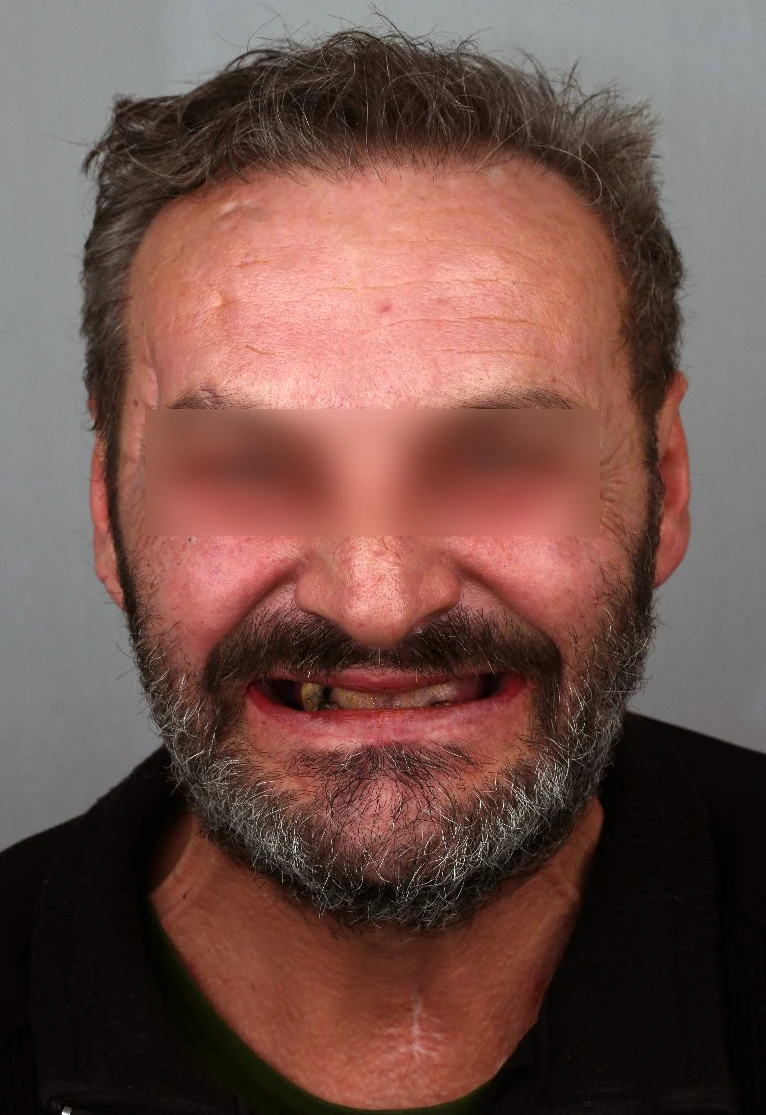 Имплантация зубов All-on-6