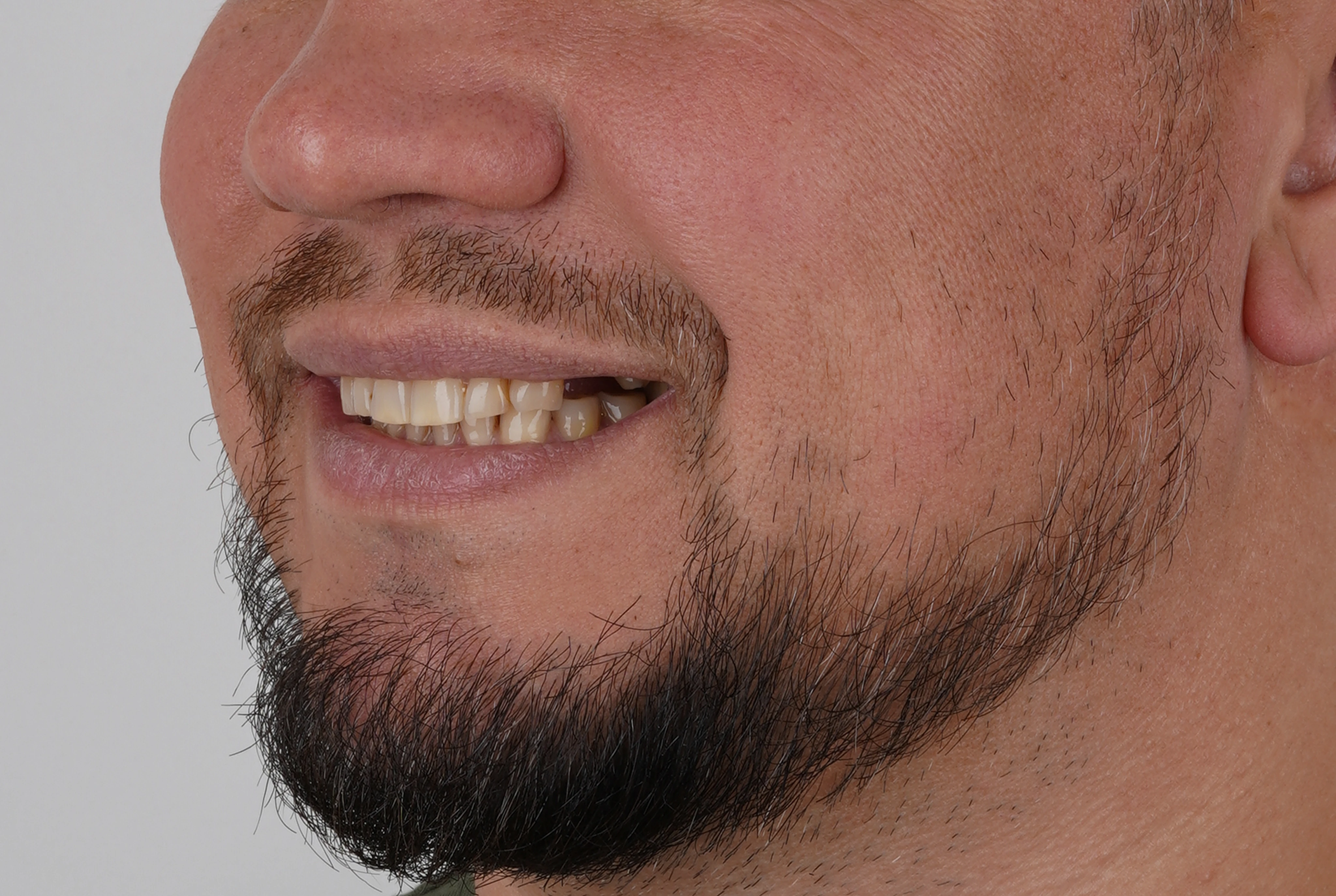 Имплантация и протезирование