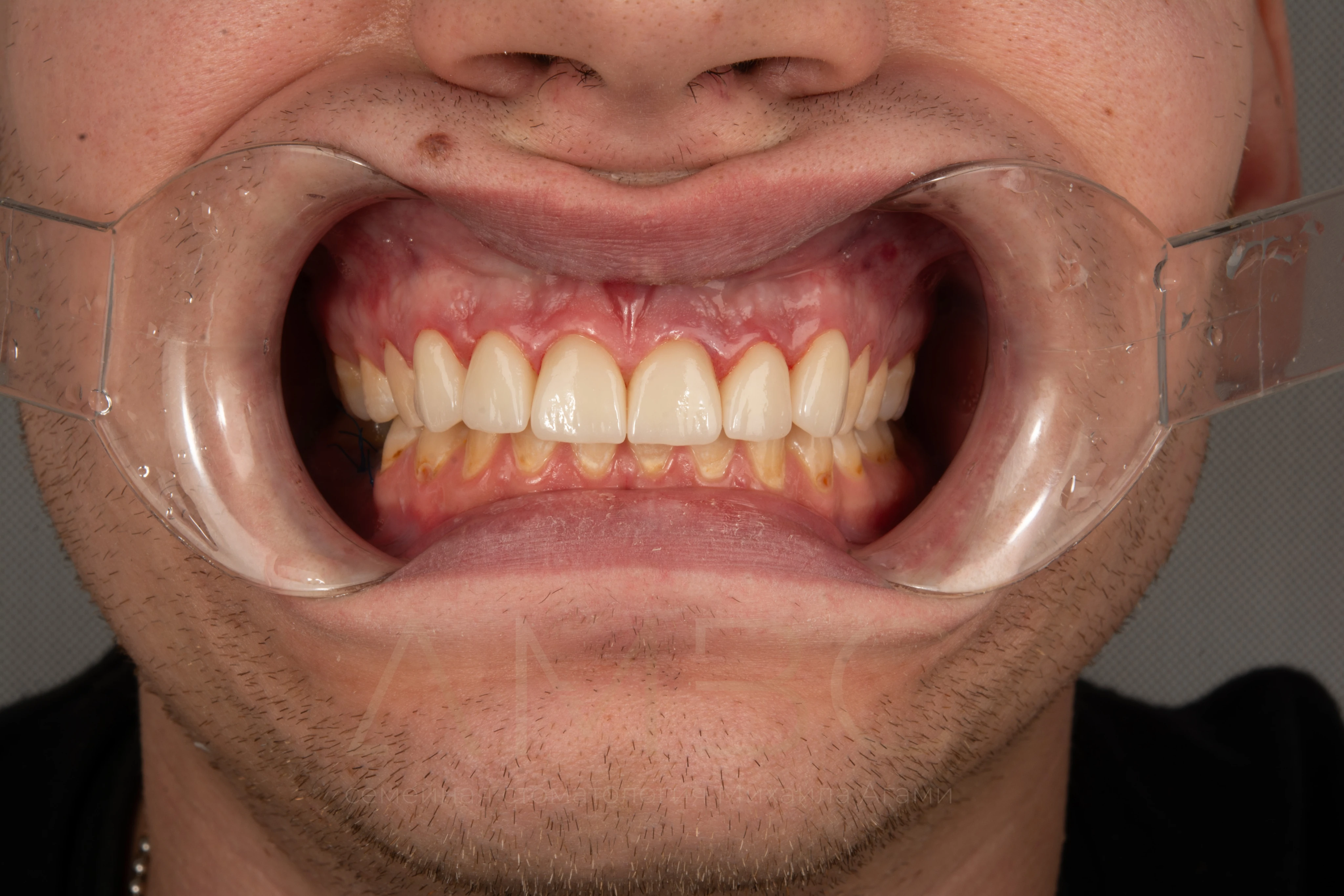 Имплантация и протезирование