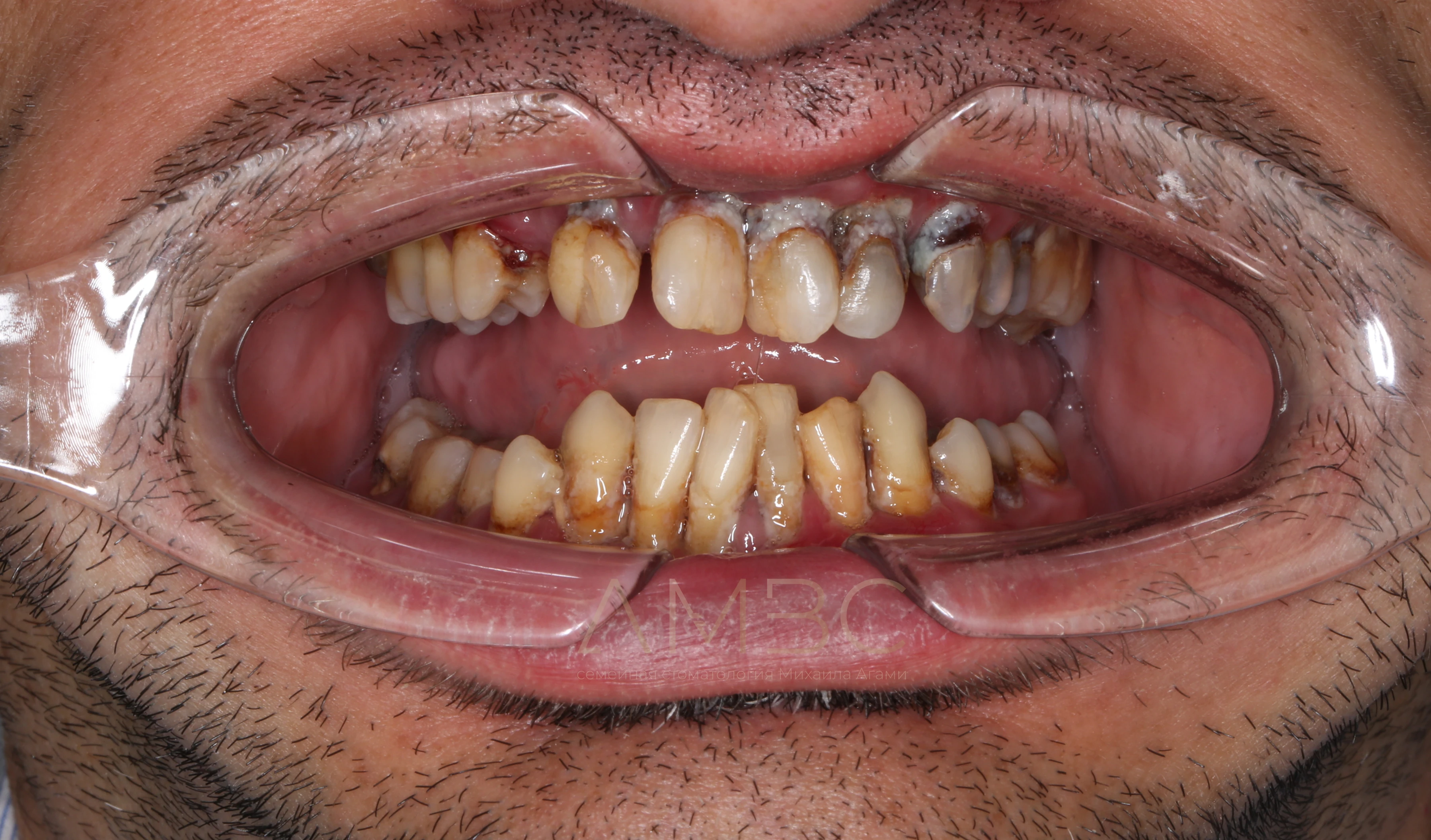 Имплантация и протезирование