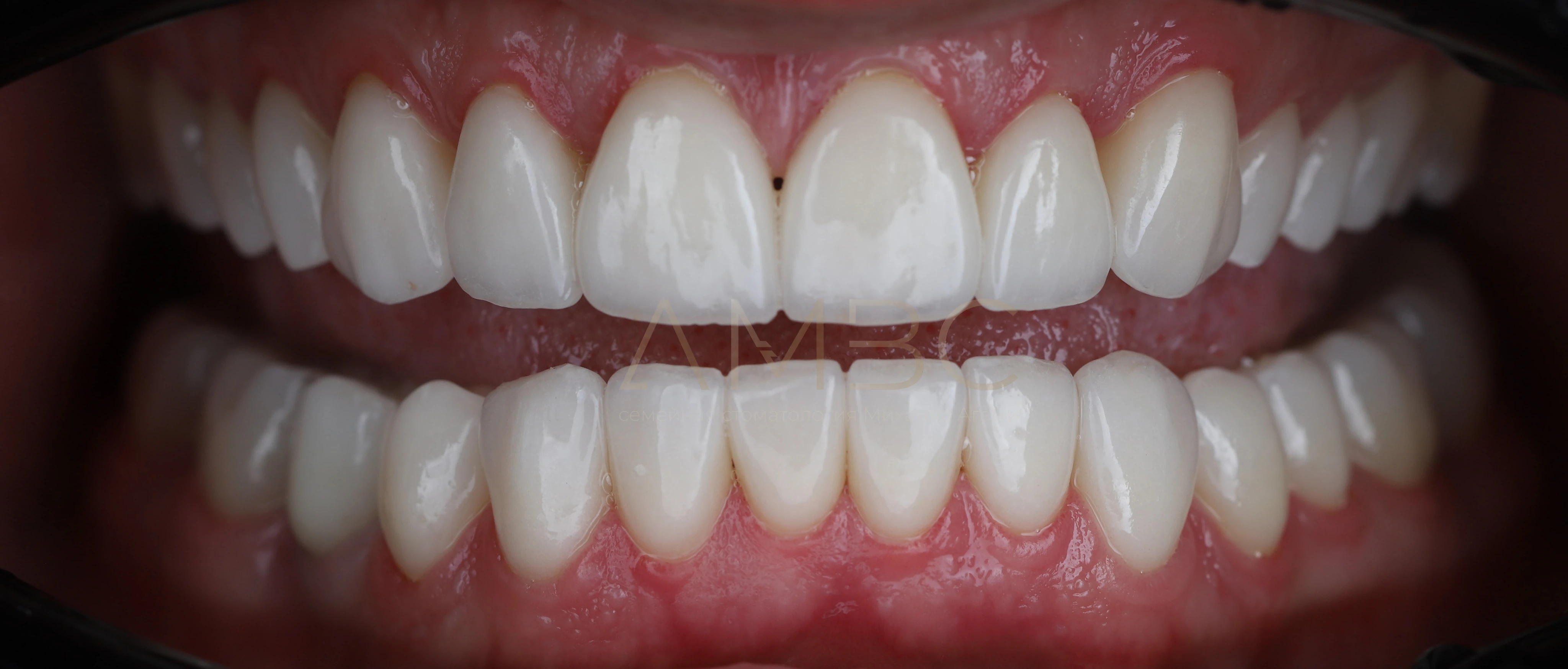 Протезирование зубов