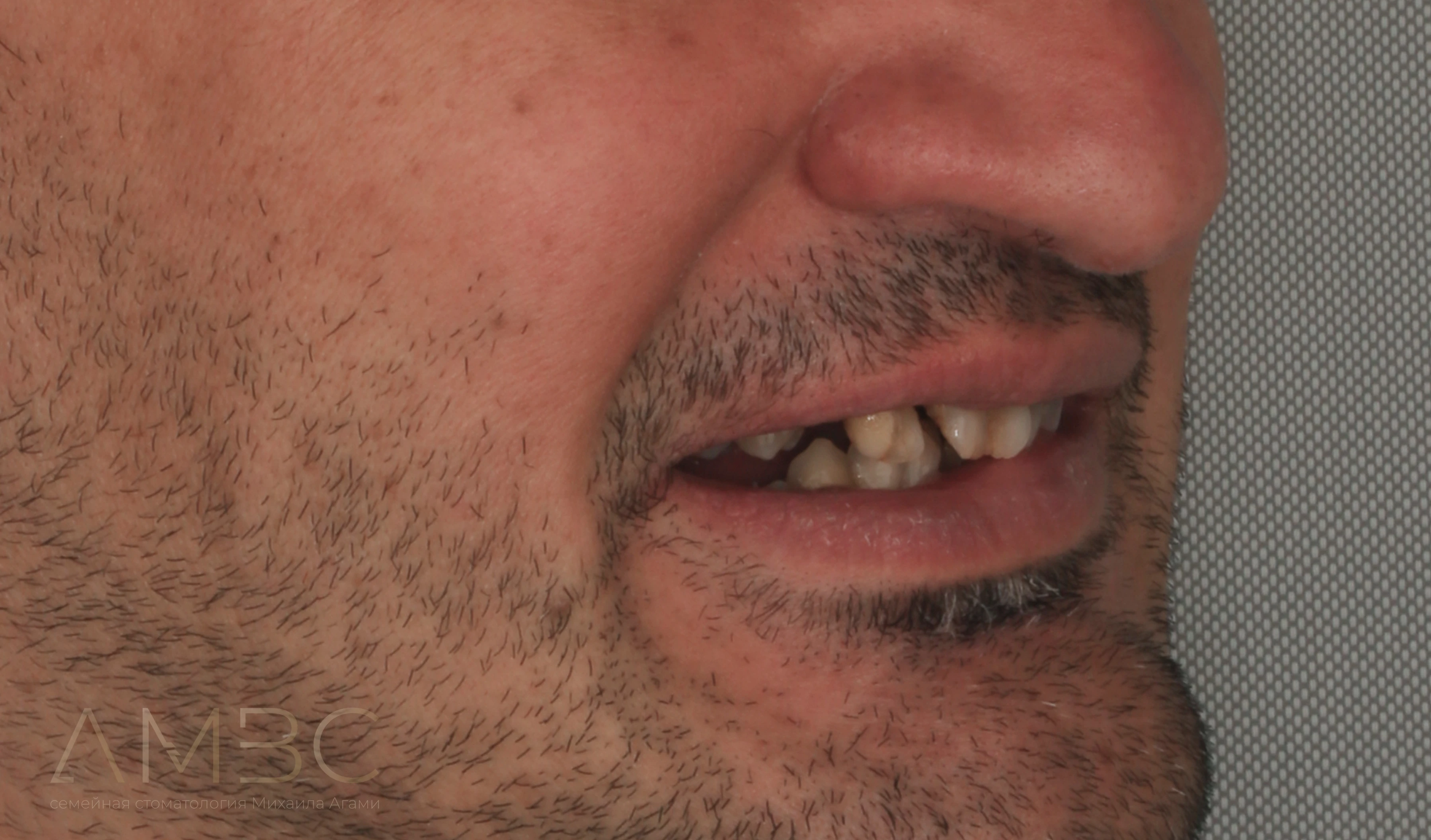 Имплантация и протезирование