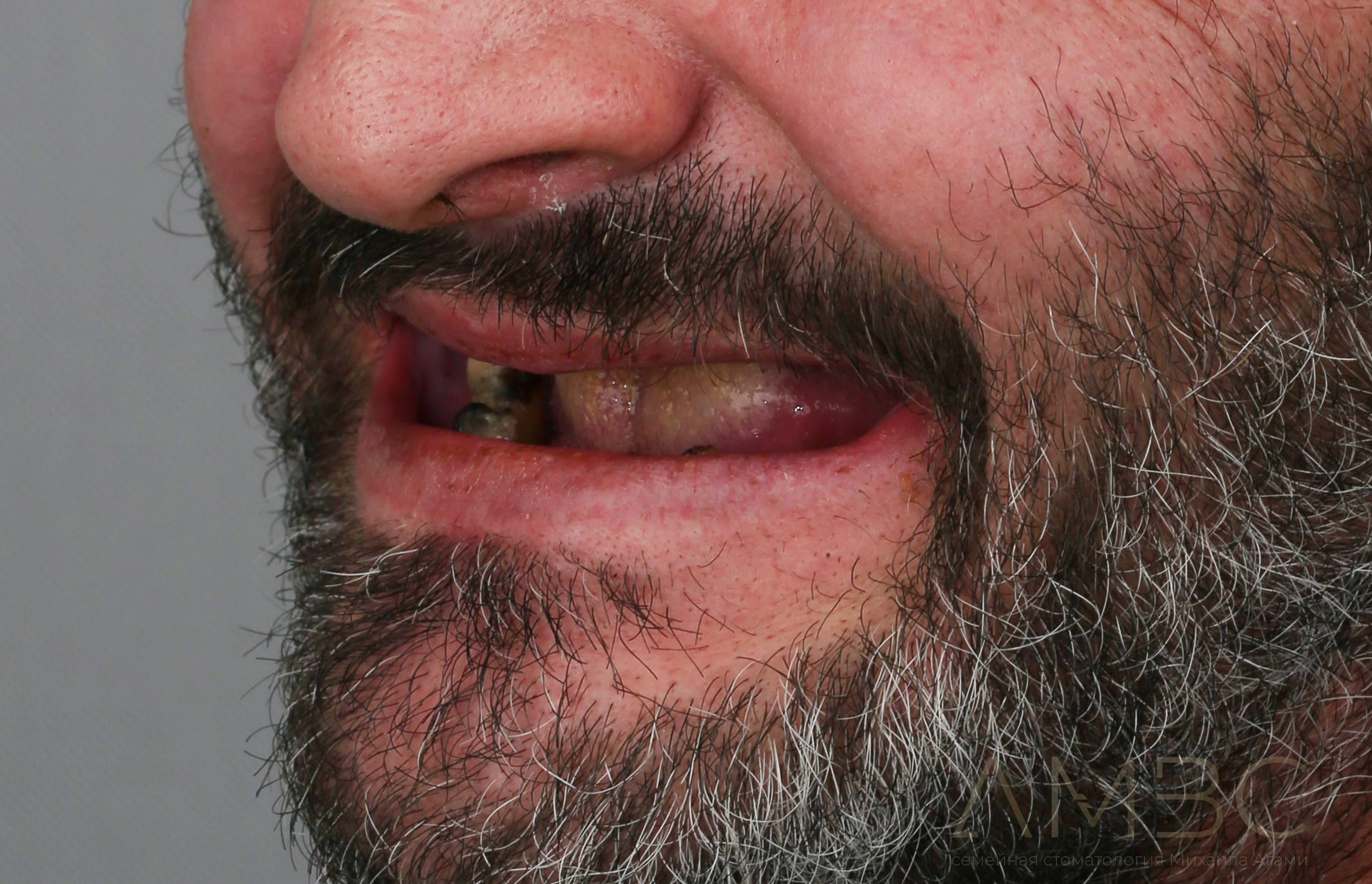 Имплантация и протезирование