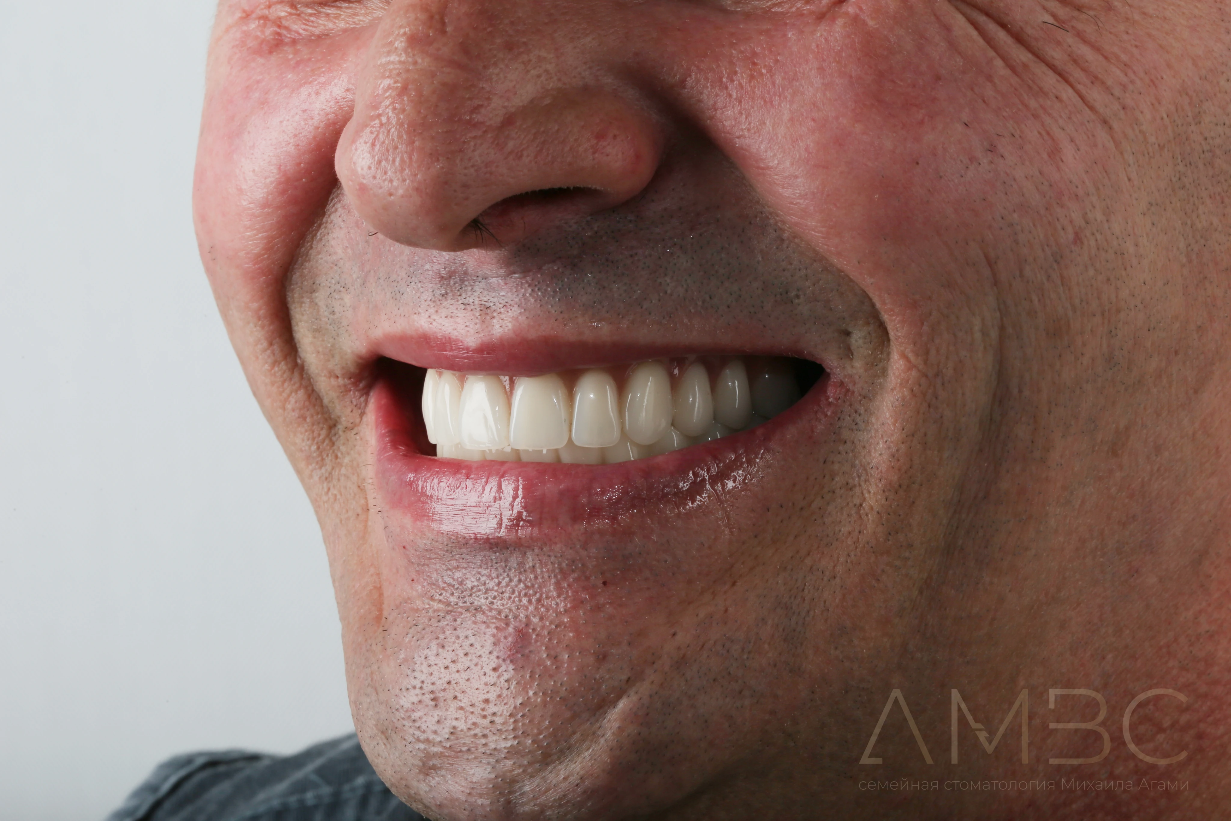 Имплантация и протезирование