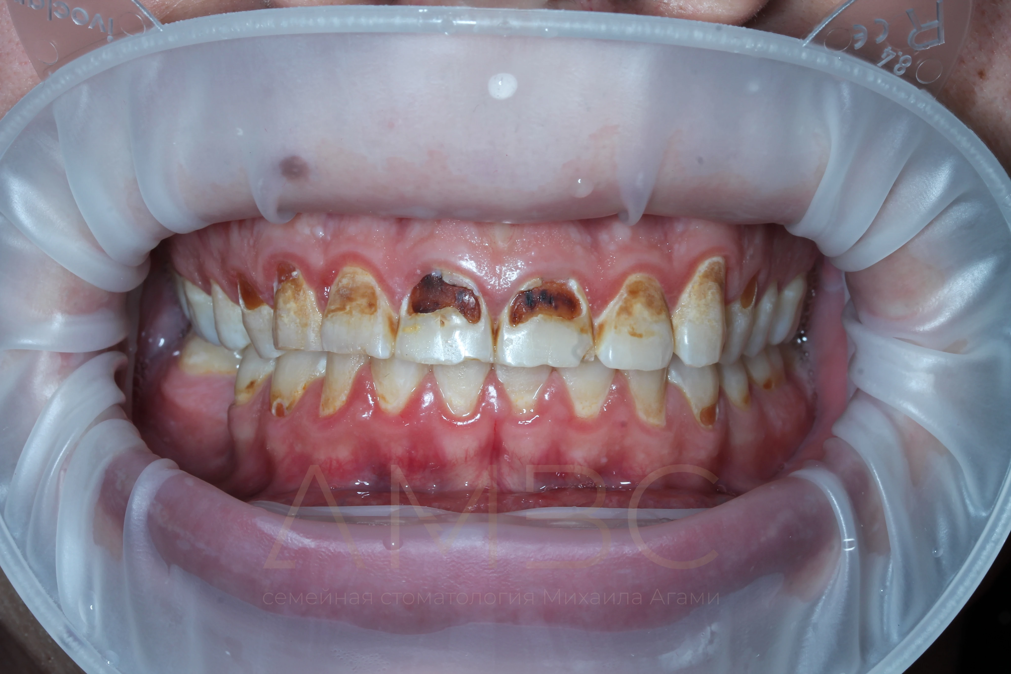 Имплантация и протезирование