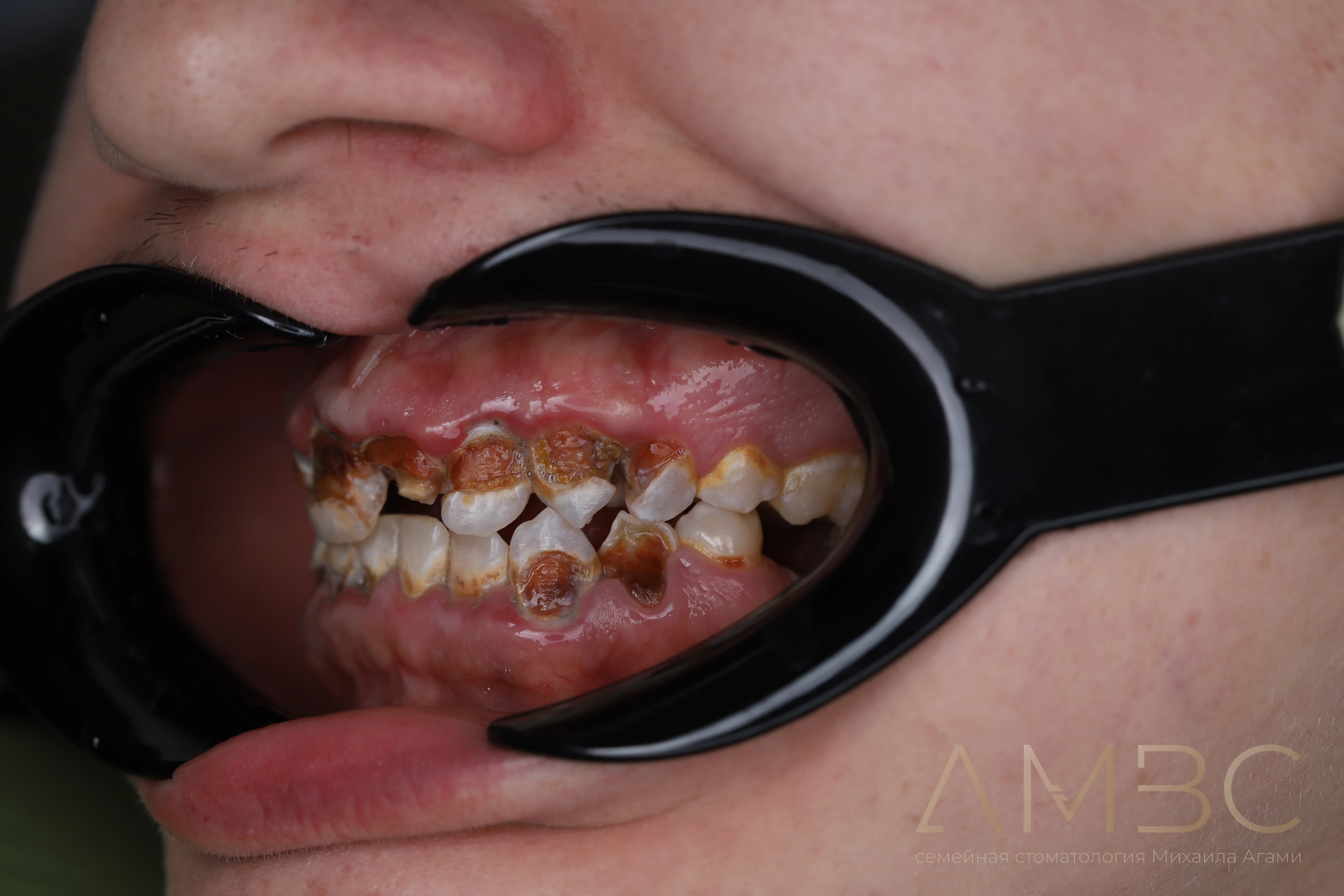 Имплантация и протезирование