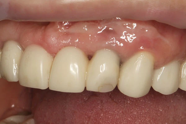 Пластика десны Пластика десны