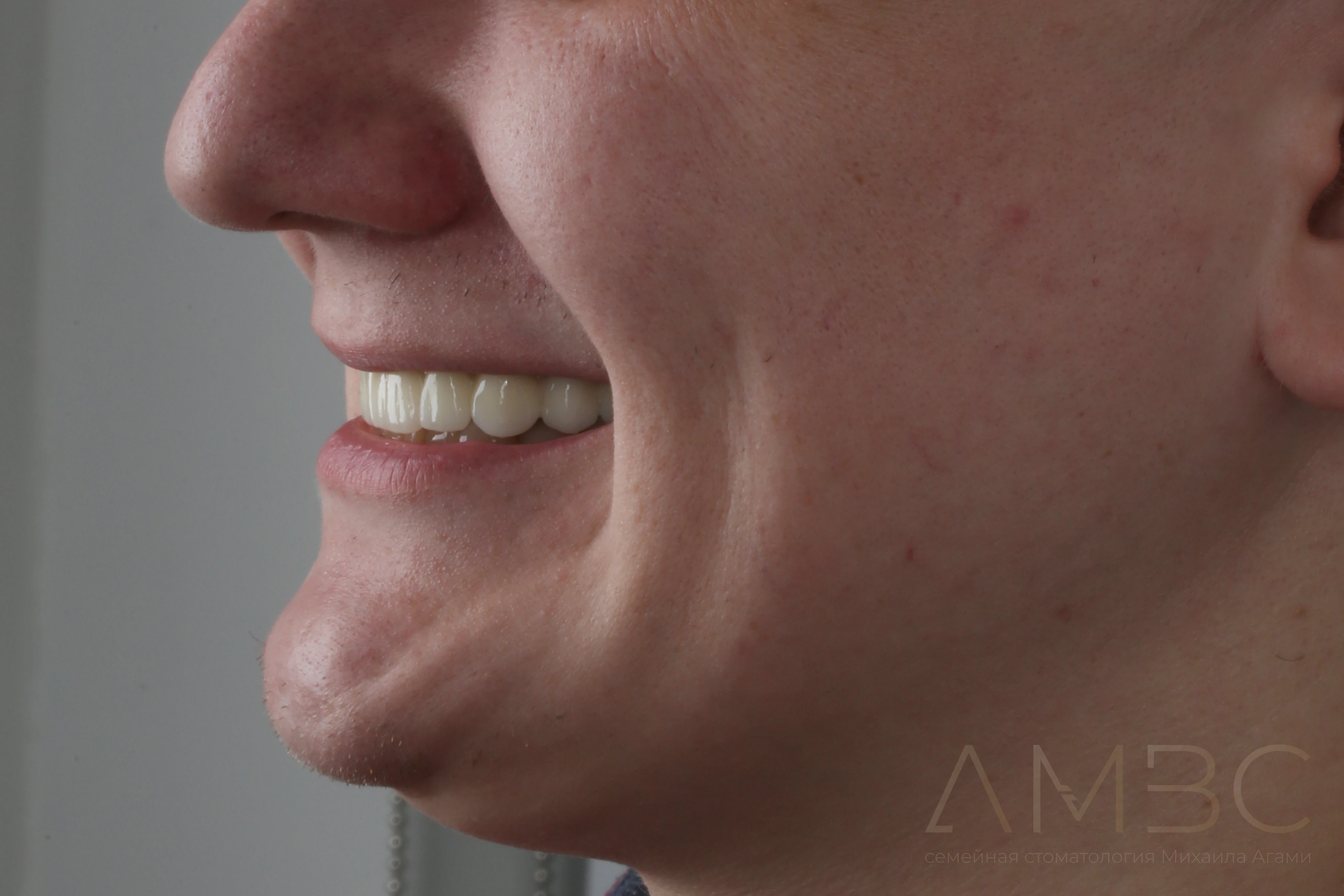 Имплантация и протезирование