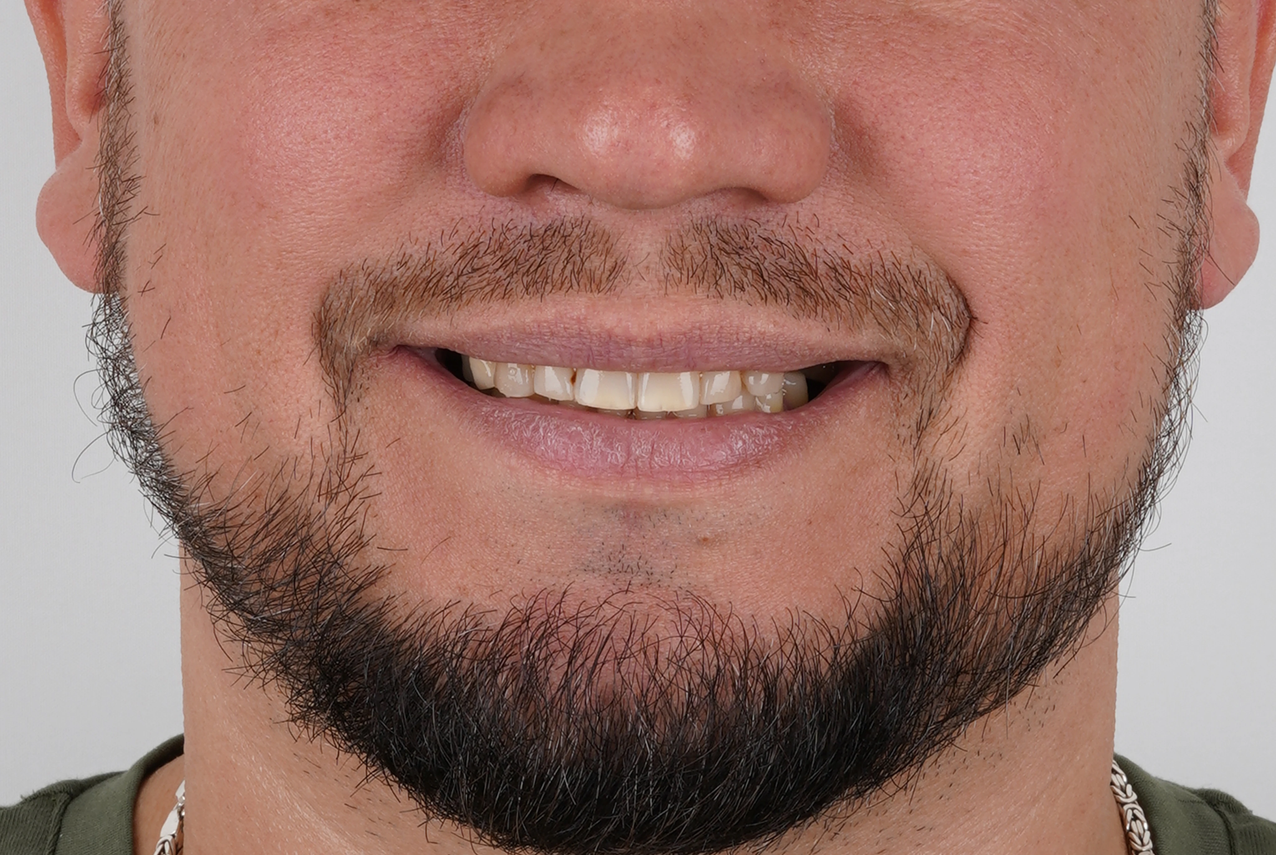 Имплантация и протезирование