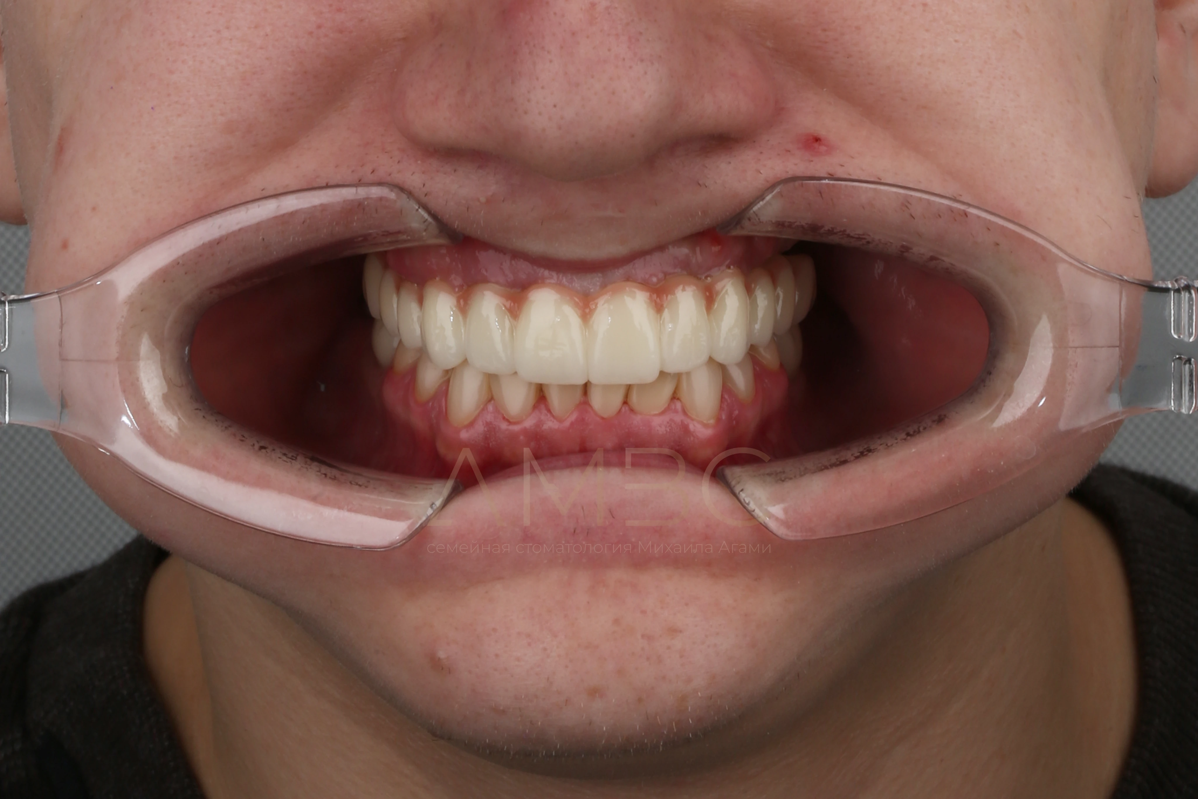 Имплантация и протезирование