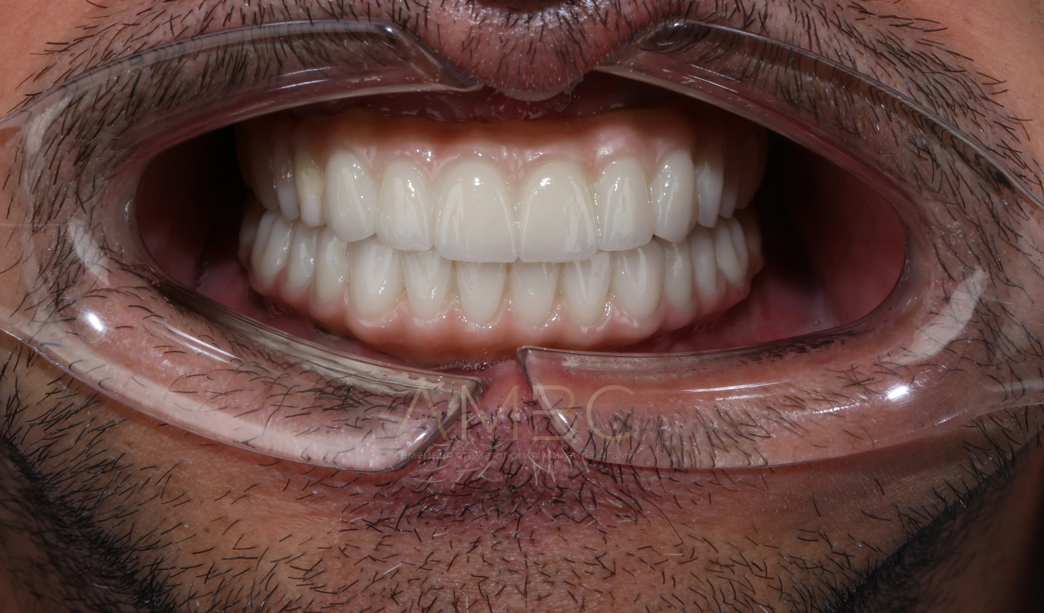 Имплантация и протезирование