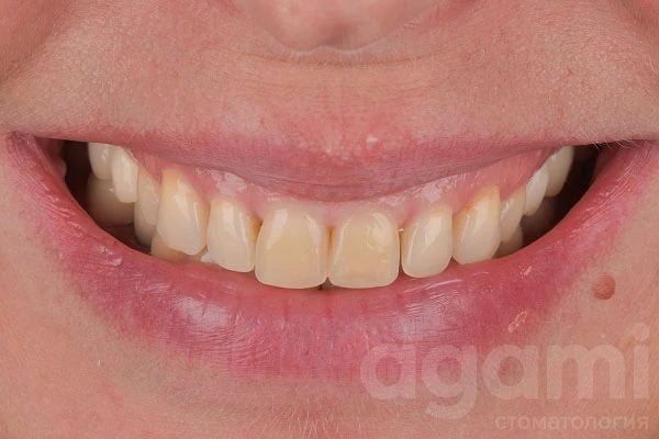 Протезирование и эстетическая реставрация