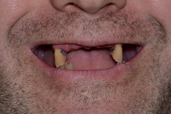 Восстановление зубных рядов