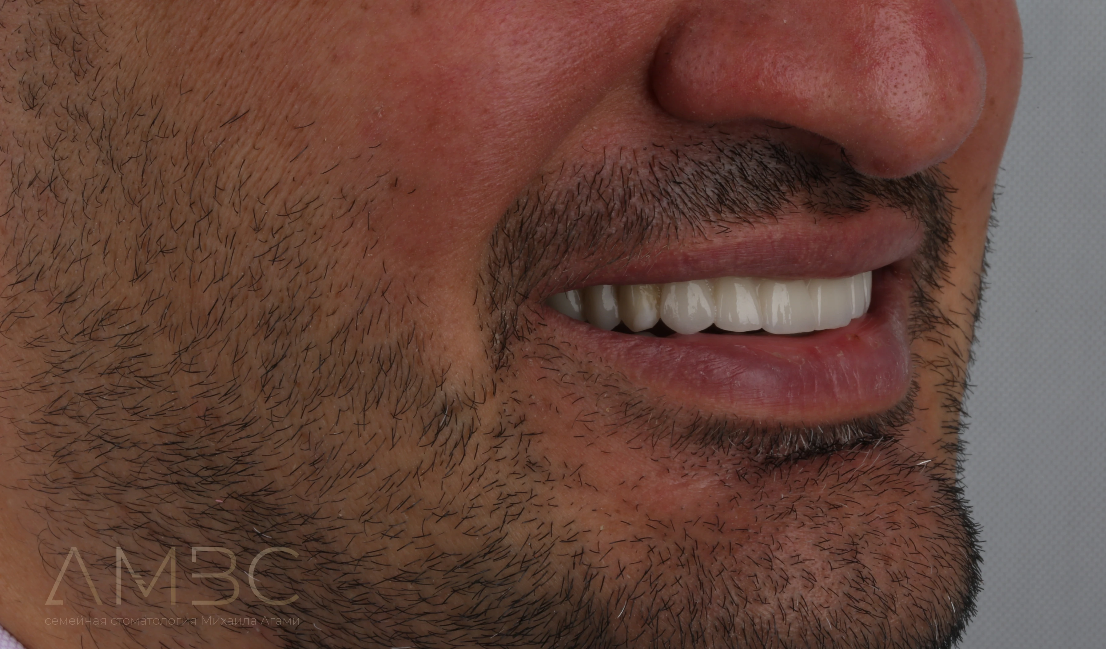 Имплантация и протезирование