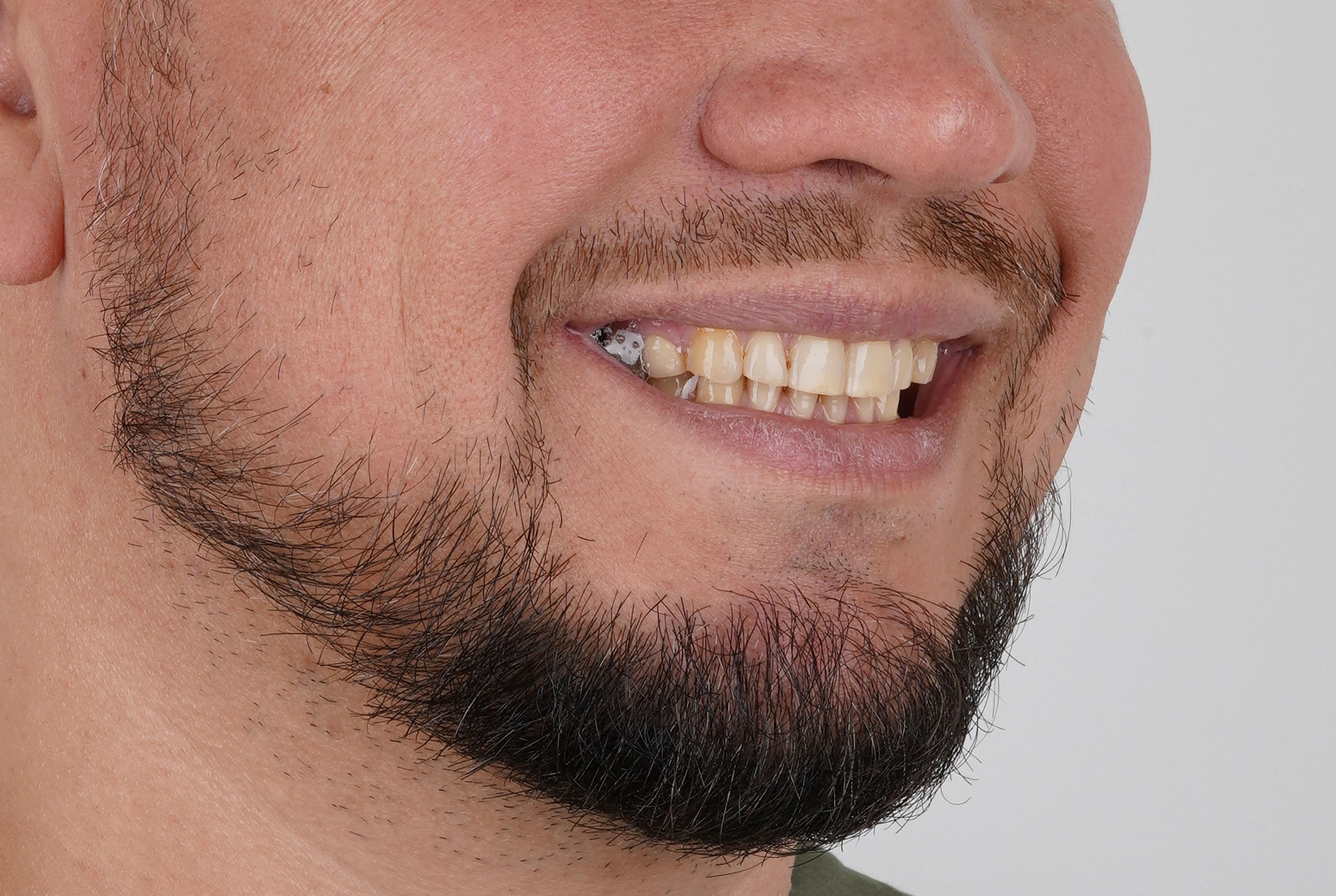 Имплантация и протезирование