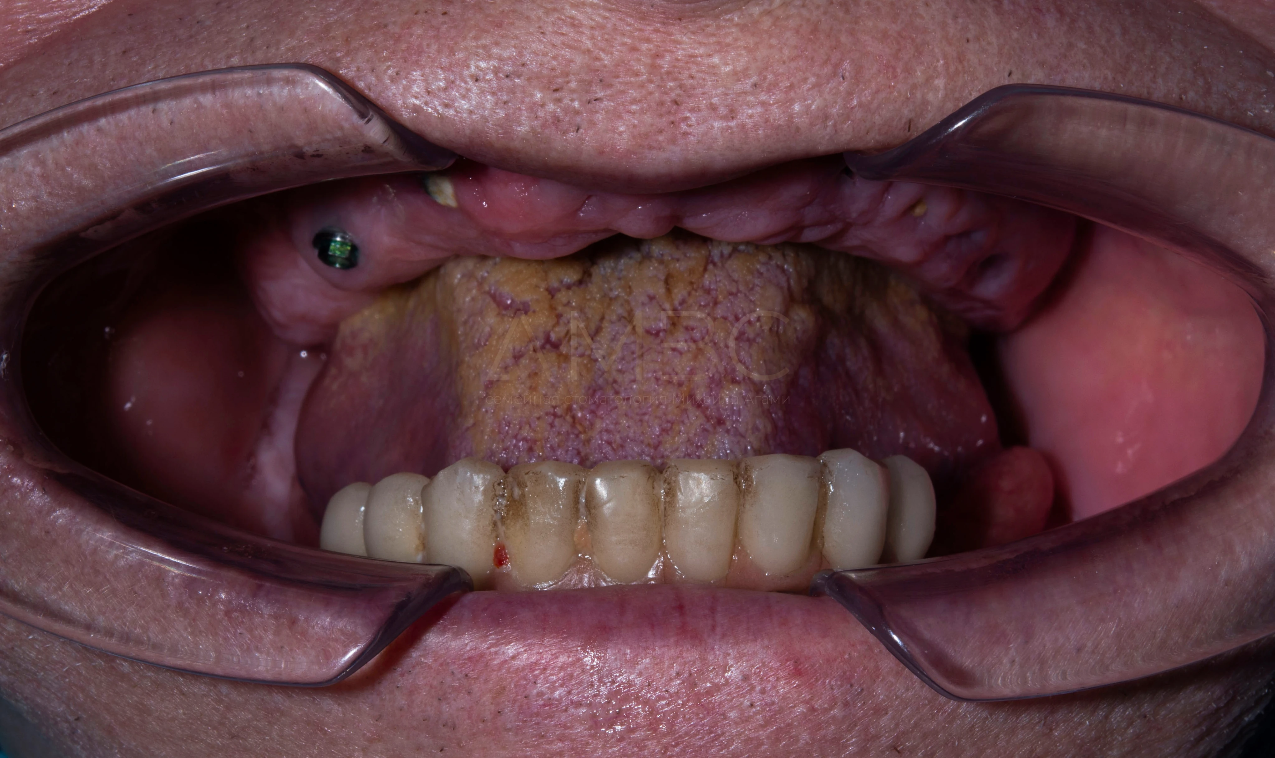 Имплантация и протезирование